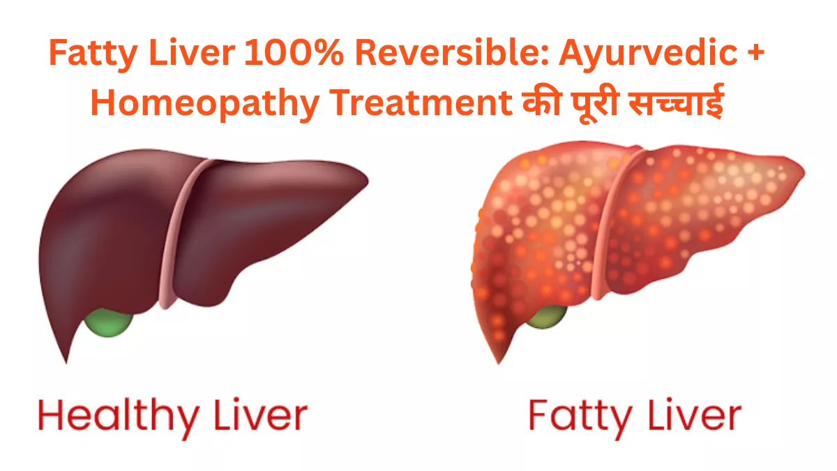 Fatty Liver 100% Reversible: Ayurvedic + Homeopathy Treatment की पूरी सच्चाई